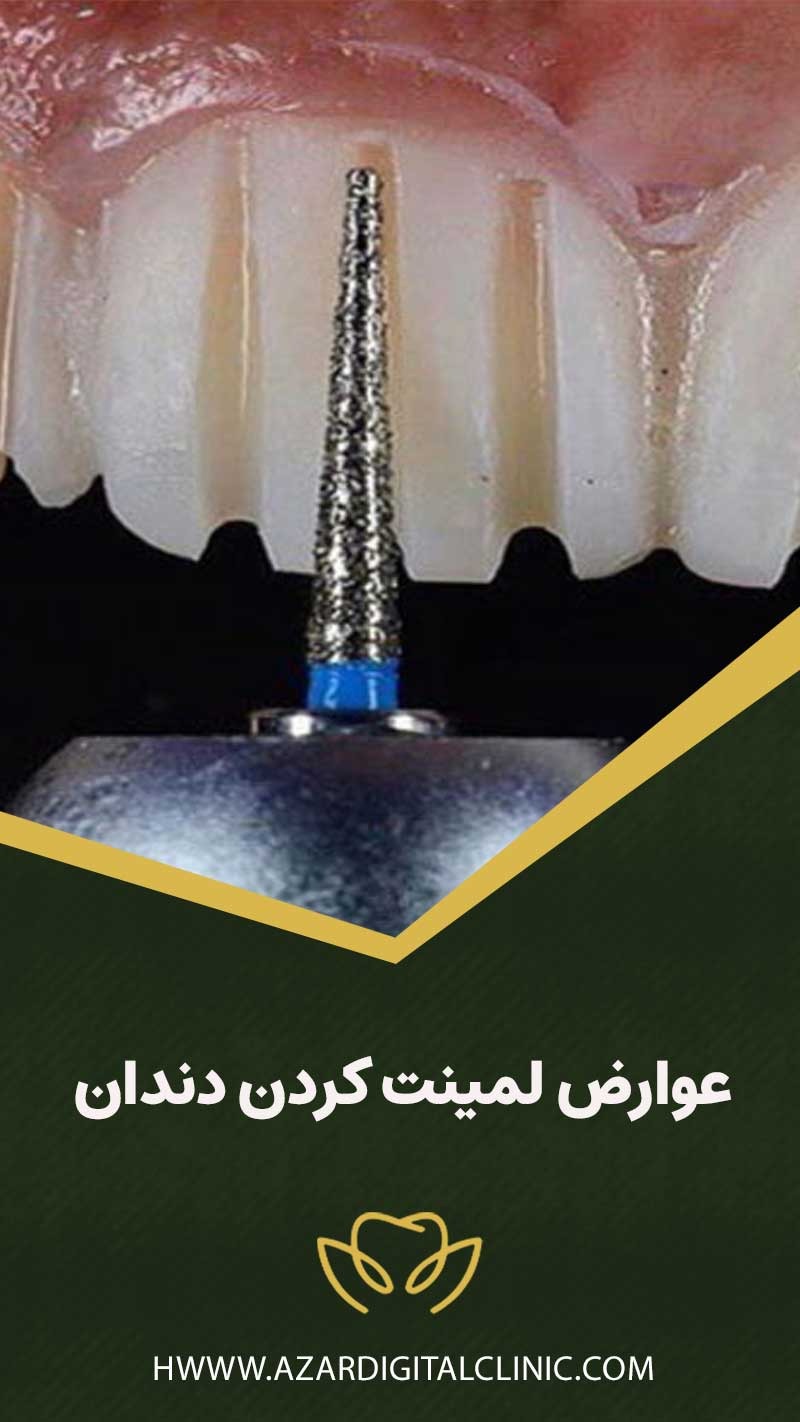 عوارض لمينت كردن دندان