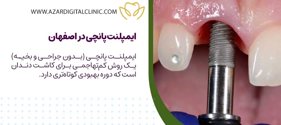 ایمپلنت پانچی در اصفهان