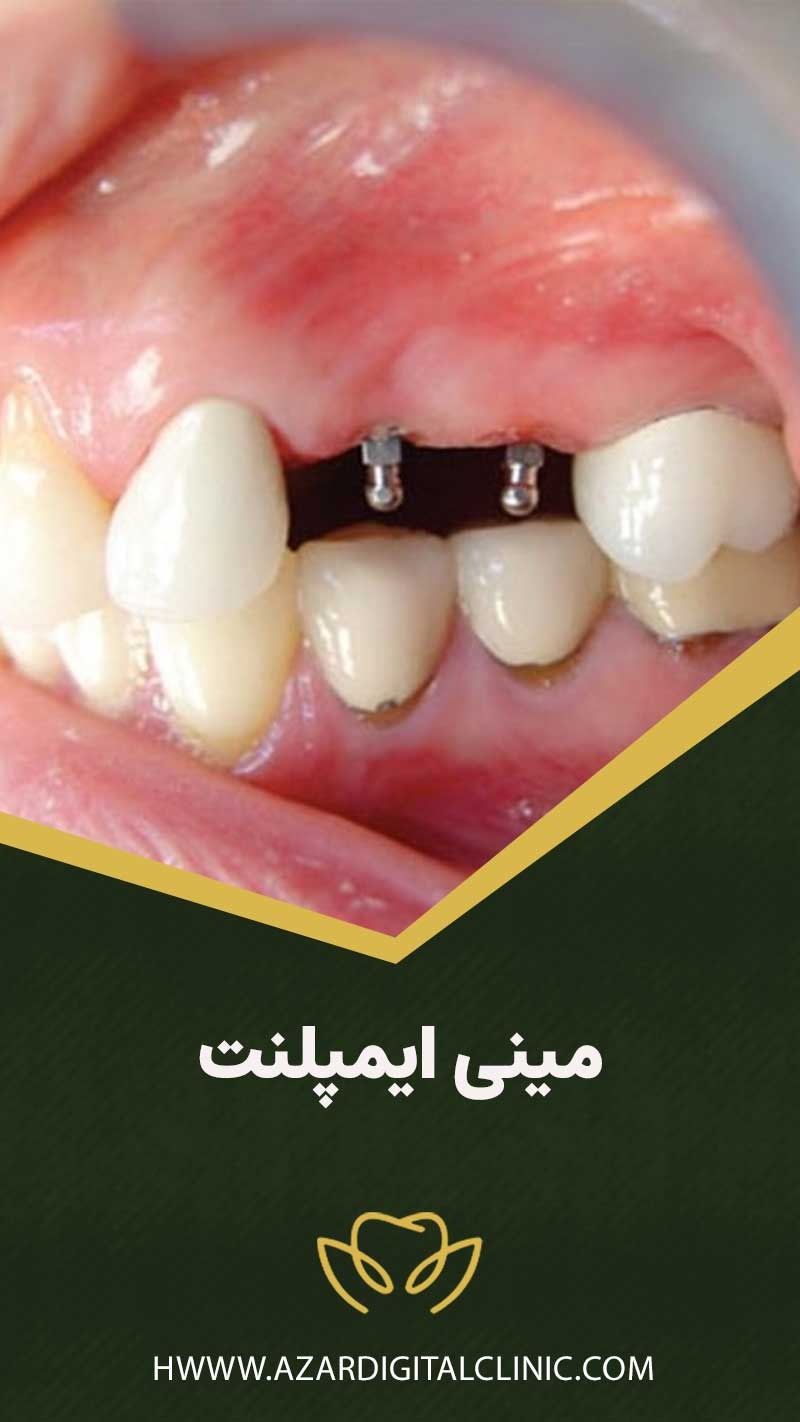 همه چیز در مورد مینی ایمپلنت ها