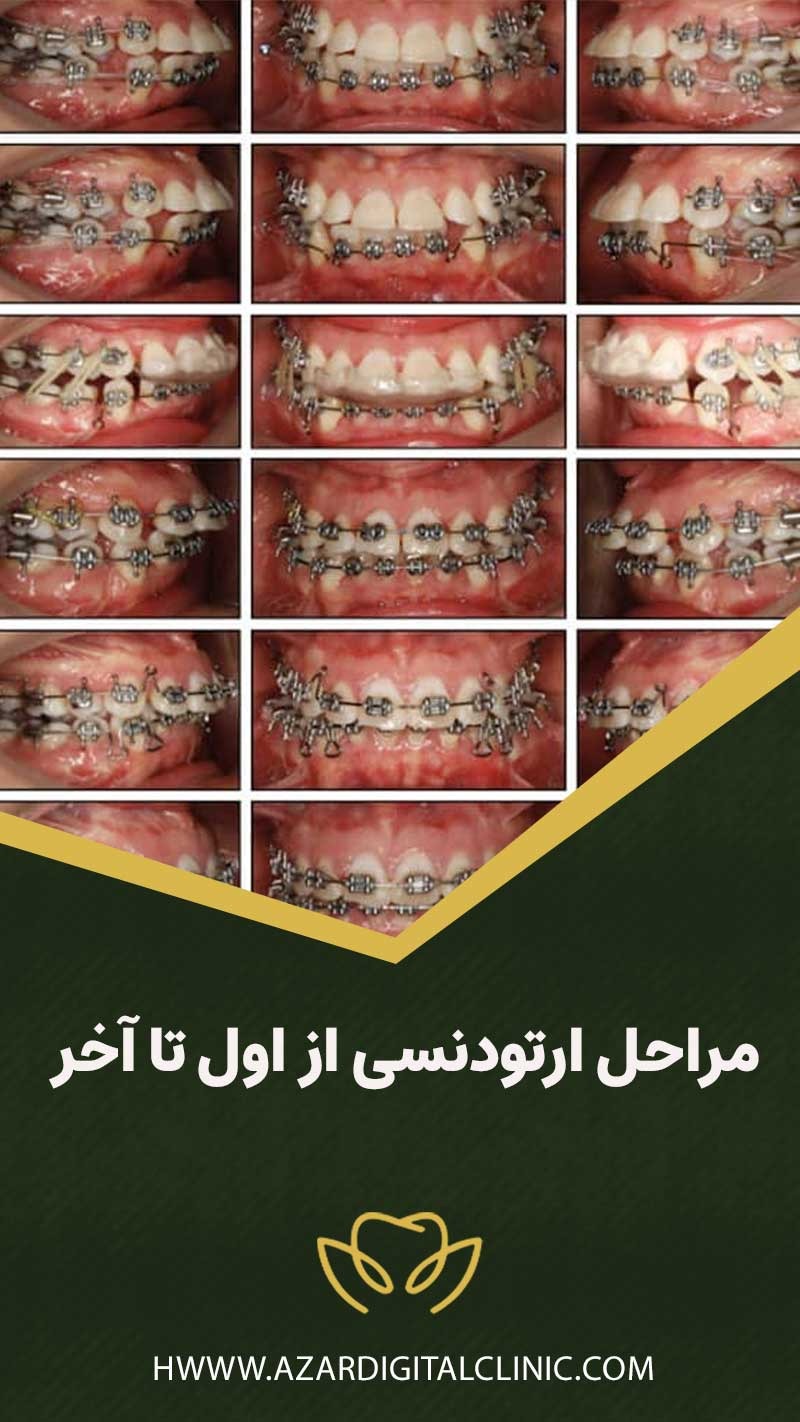 مراحل ارتودنسی از اول تا آخر