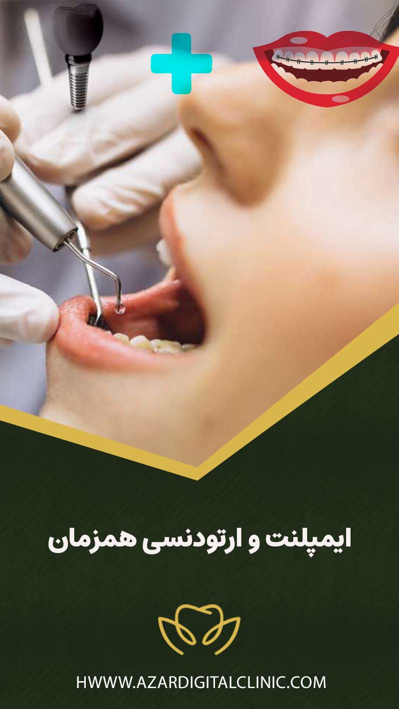 ایمپلنت و ارتودنسی همزمان
