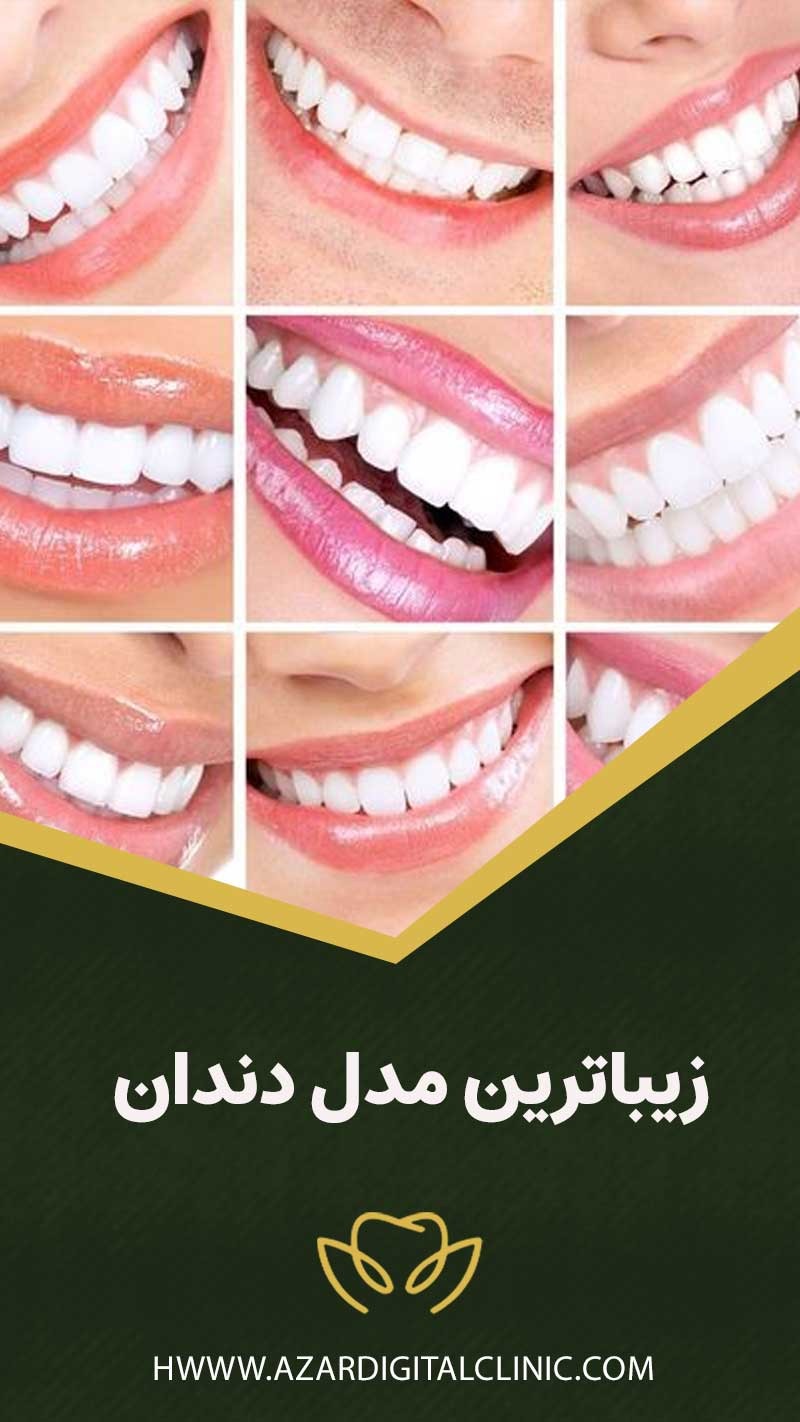 زيباترين مدل دندان (زیباترین مدل لمینت+کامپوزیت)