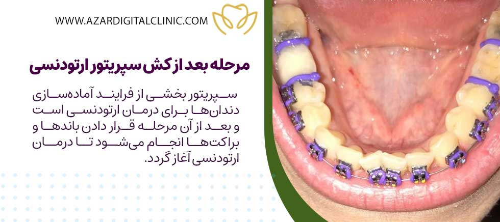 مرحله بعد از کش سپریتور ارتودنسی
