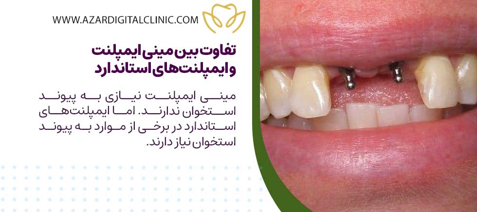 چه تفاوت‌هایی بین مینی ایمپلنت و ایمپلنت‌های استاندارد وجود دارد؟