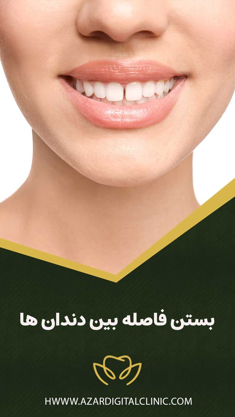 برای بستن فاصله بین دندان ها چه باید کرد؟