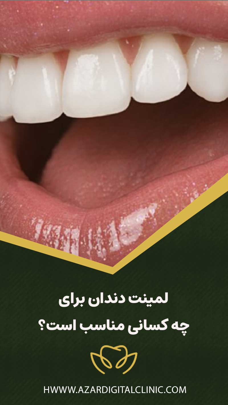 لمینت دندان برای چه کسانی مناسب است؟