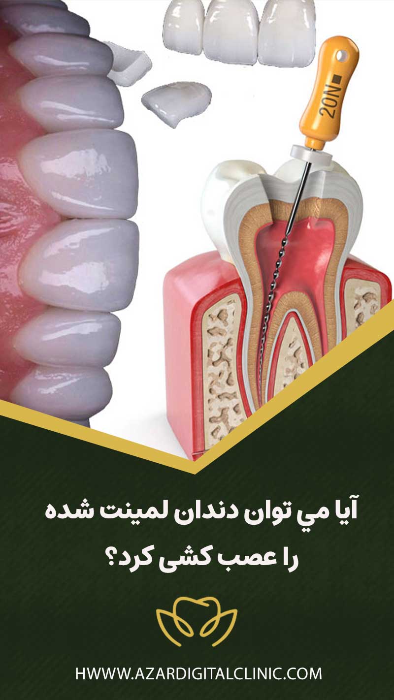 آيا مي توان دندان لمينت شده را عصب كشي كرد؟