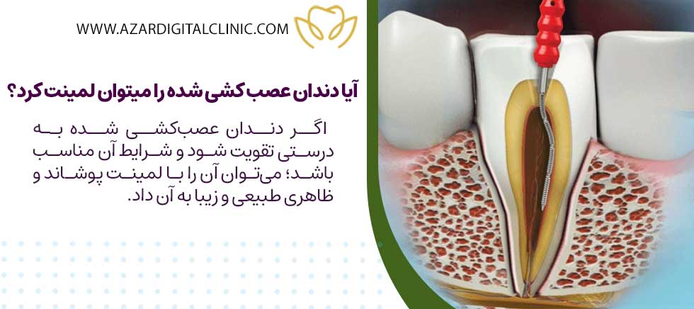 آیا دندان عصب کشی شده را میتوان لمینت کرد؟
