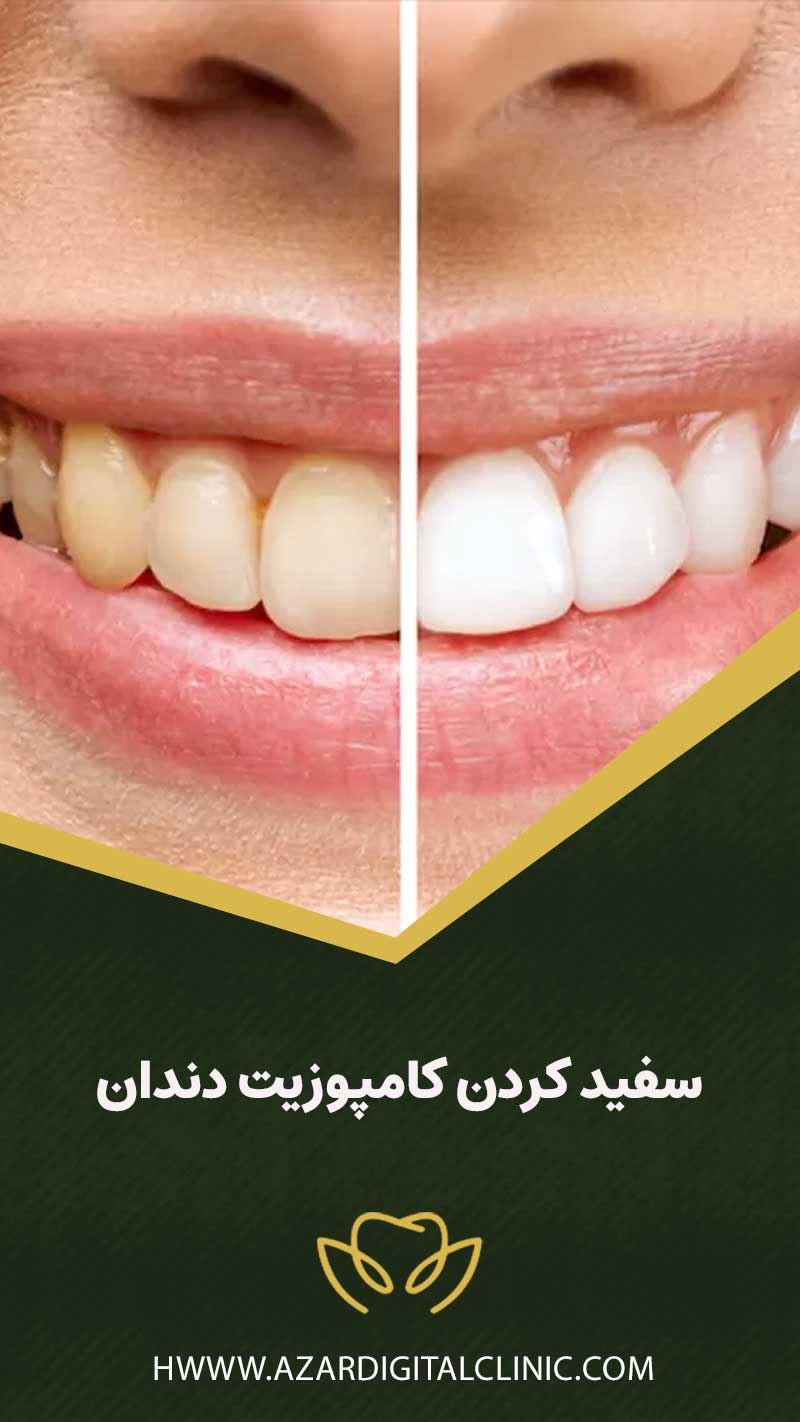 سفيد كردن كامپوزيت دندان