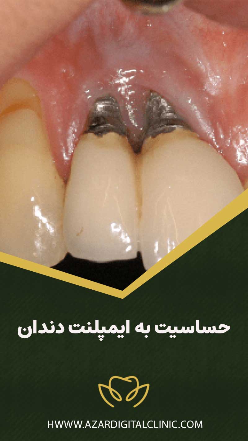 حساسیت به ایمپلنت دندان
