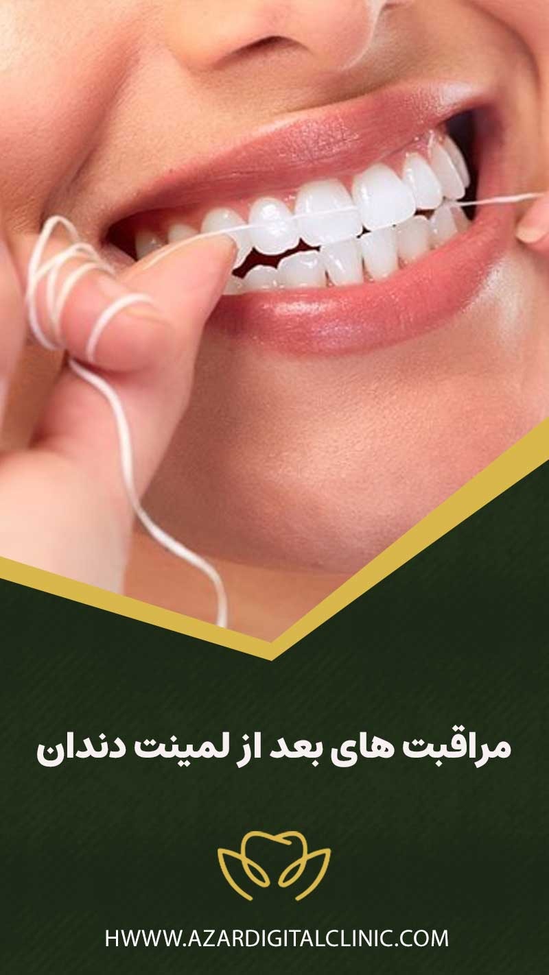مراقبت های بعد از لمینت دندان