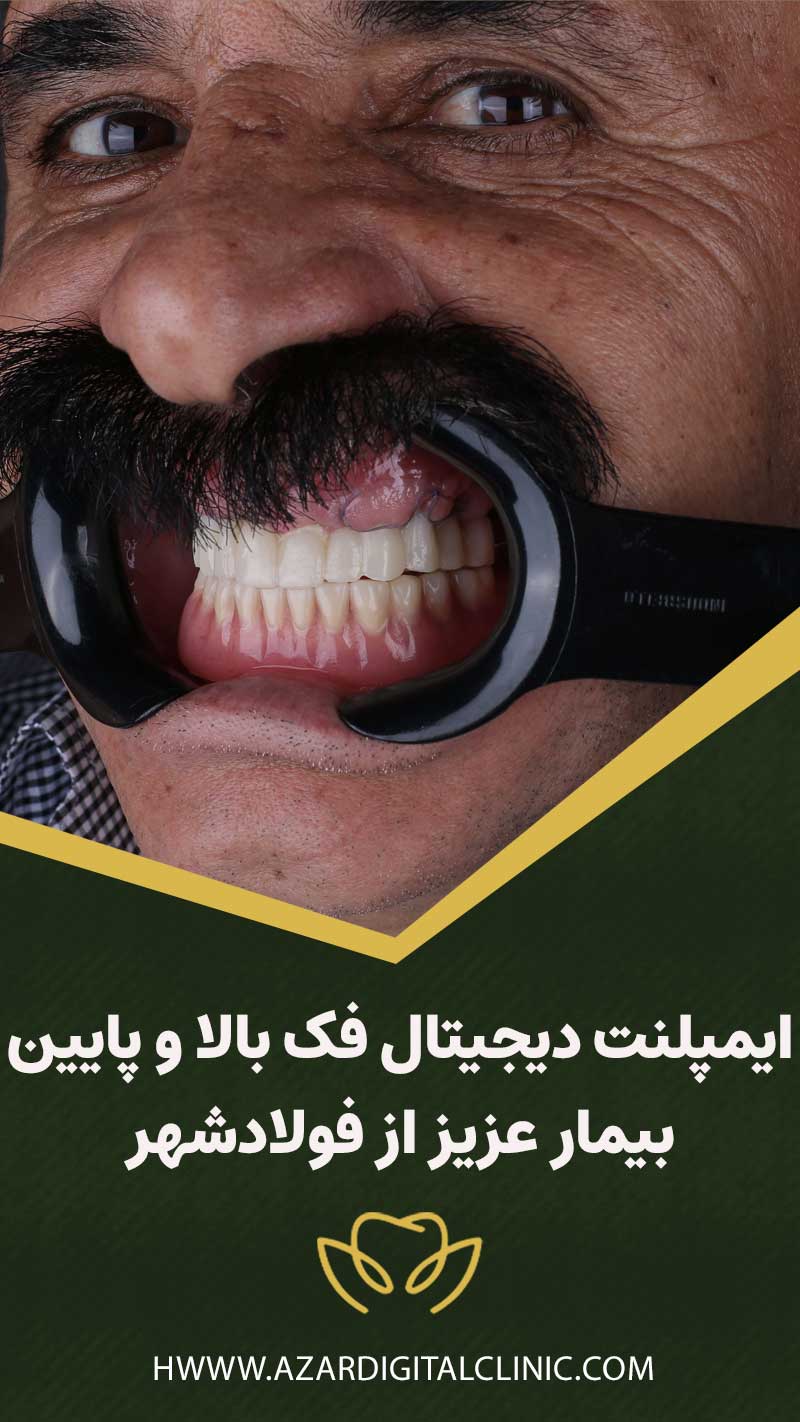 ایمپلنت در فولادشهر برای فک بالا و پایین بیمار عزیز
