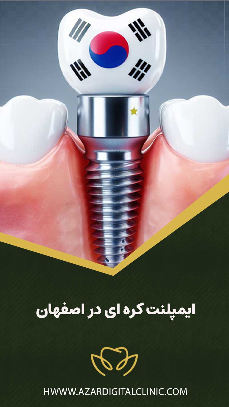 ایمپلنت کره ای در اصفهان