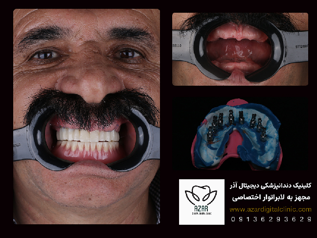 ایمپلنت در فولادشهر در کلینیک آذر برای فک بالا و پایین بیمار عزیز