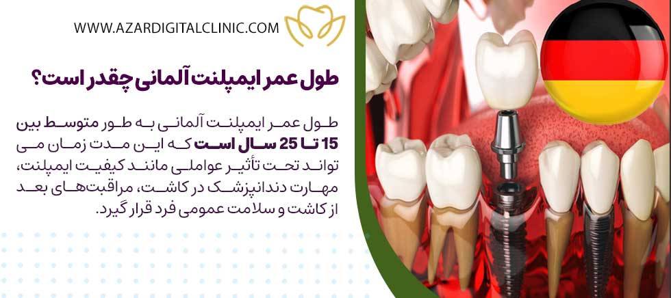 طول عمر ایمپلنت آلمانی