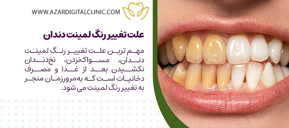 علت تغییر رنگ لمینت دندان