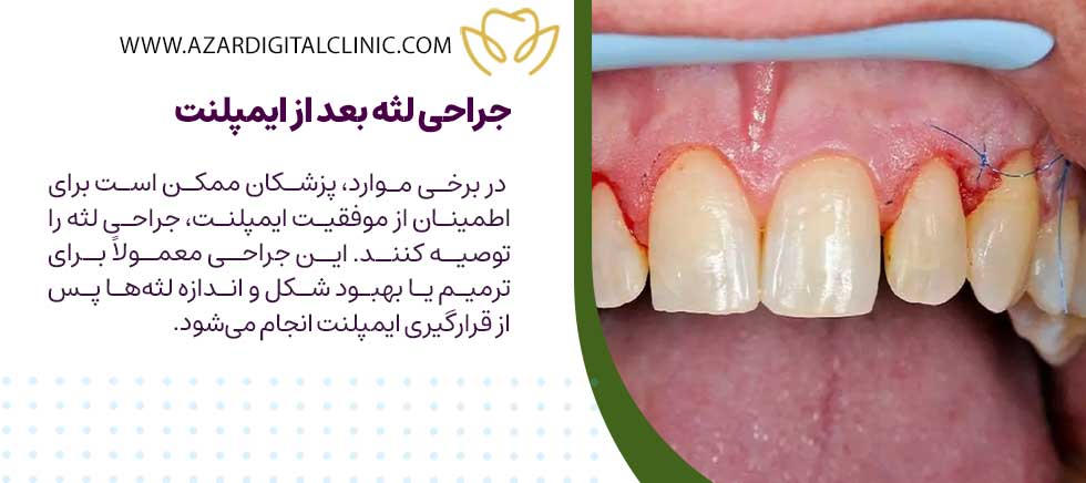 جراحی لثه بعد از ایمپلنت