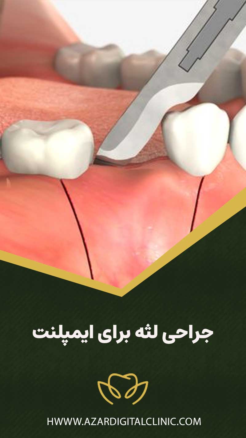 جراحی لثه برای ایمپلنت