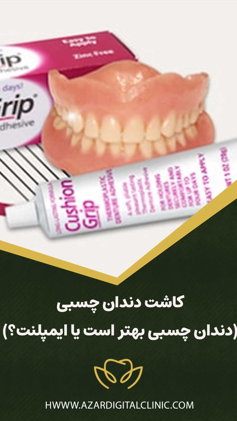 کاشت دندان چسبی (دندان چسبی بهتر است یا ایمپلنت؟)