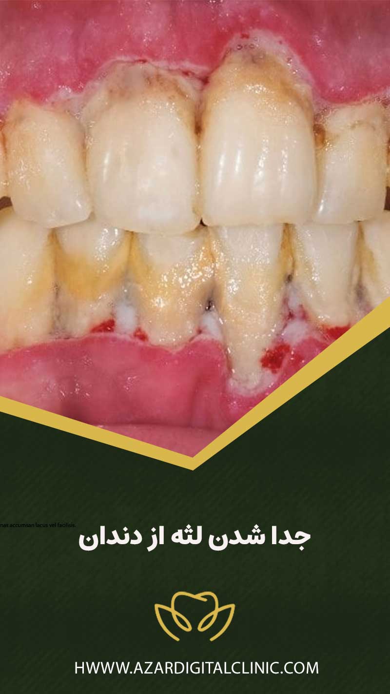 جدا شدن لثه از دندان