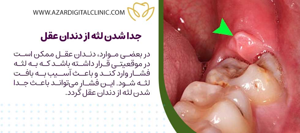 جدا شدن لثه از دندان عقل