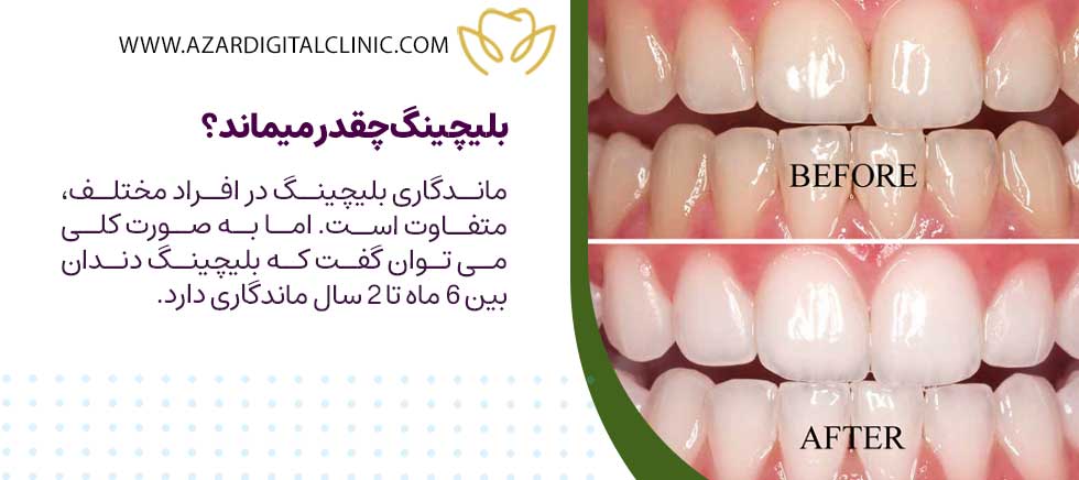 بلیچینگ چقدر میماند؟