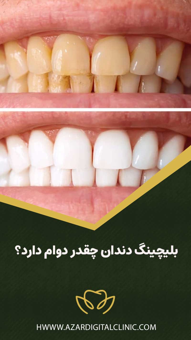 بلیچینگ دندان چقدر دوام دارد؟