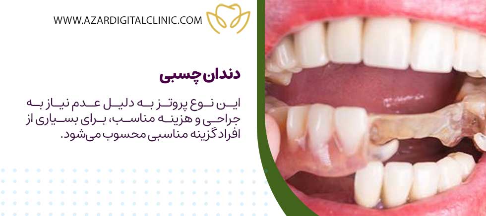 عکس دندان چسبی
