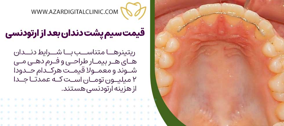 قیمت سیم پشت دندان بعد از ارتودنسی