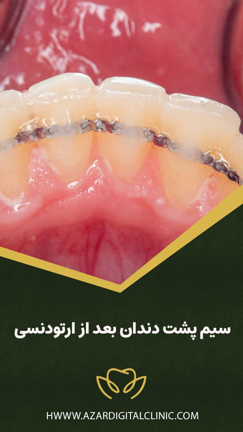 سیم پشت دندان بعد از ارتودنسی