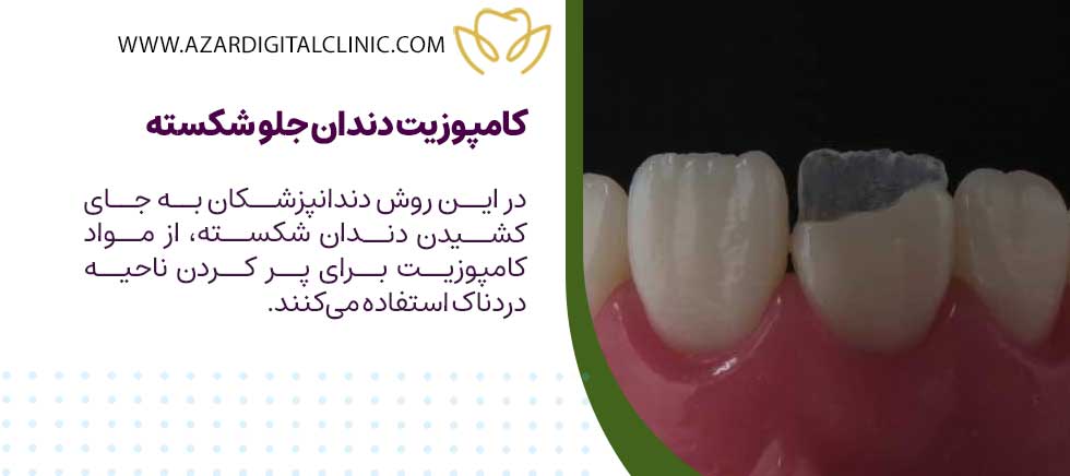 کامپوزیت دندان جلو شکسته
