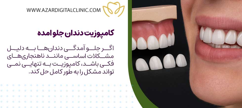 کامپوزیت دندان جلو امده