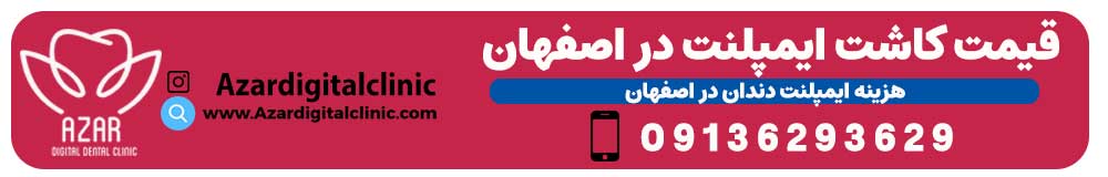 قیمت ایمپلنت در اصفهان