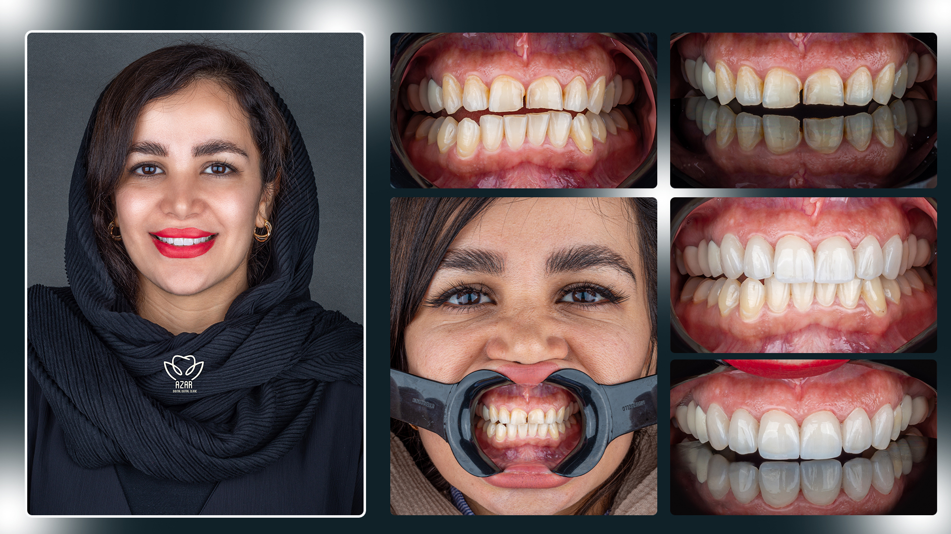 لمینیت سرامیکی دندان در اصفهان در کلینیک دندانپزشکی دیجیتال آذر