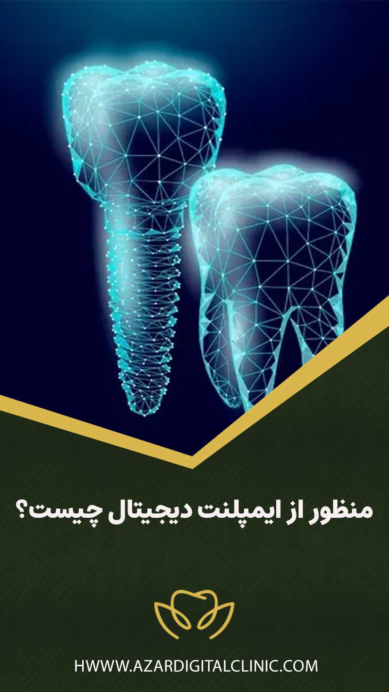 منظور از ایمپلنت دیجیتال چیست؟