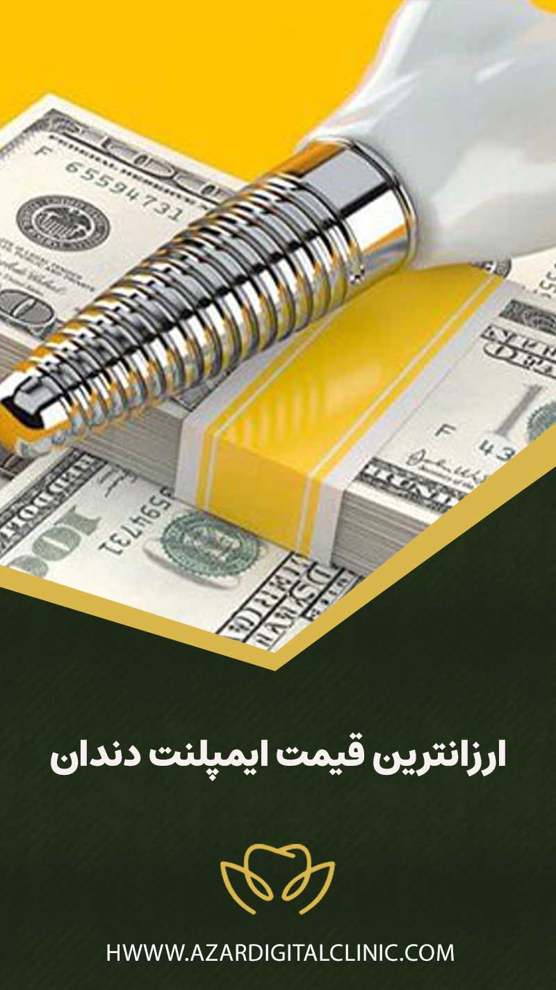 ارزانترین قیمت ایمپلنت دندان
