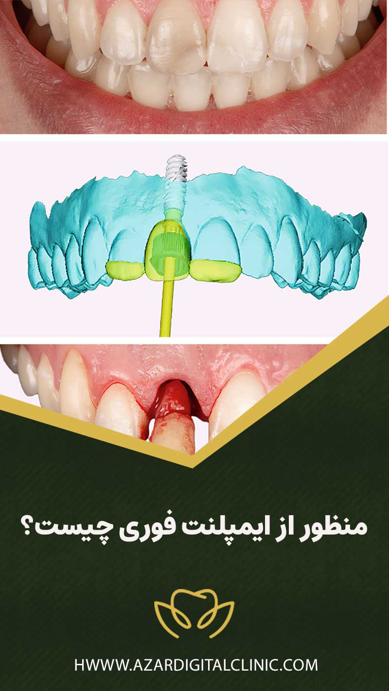 منظور از ایمپلنت فوری چیست؟