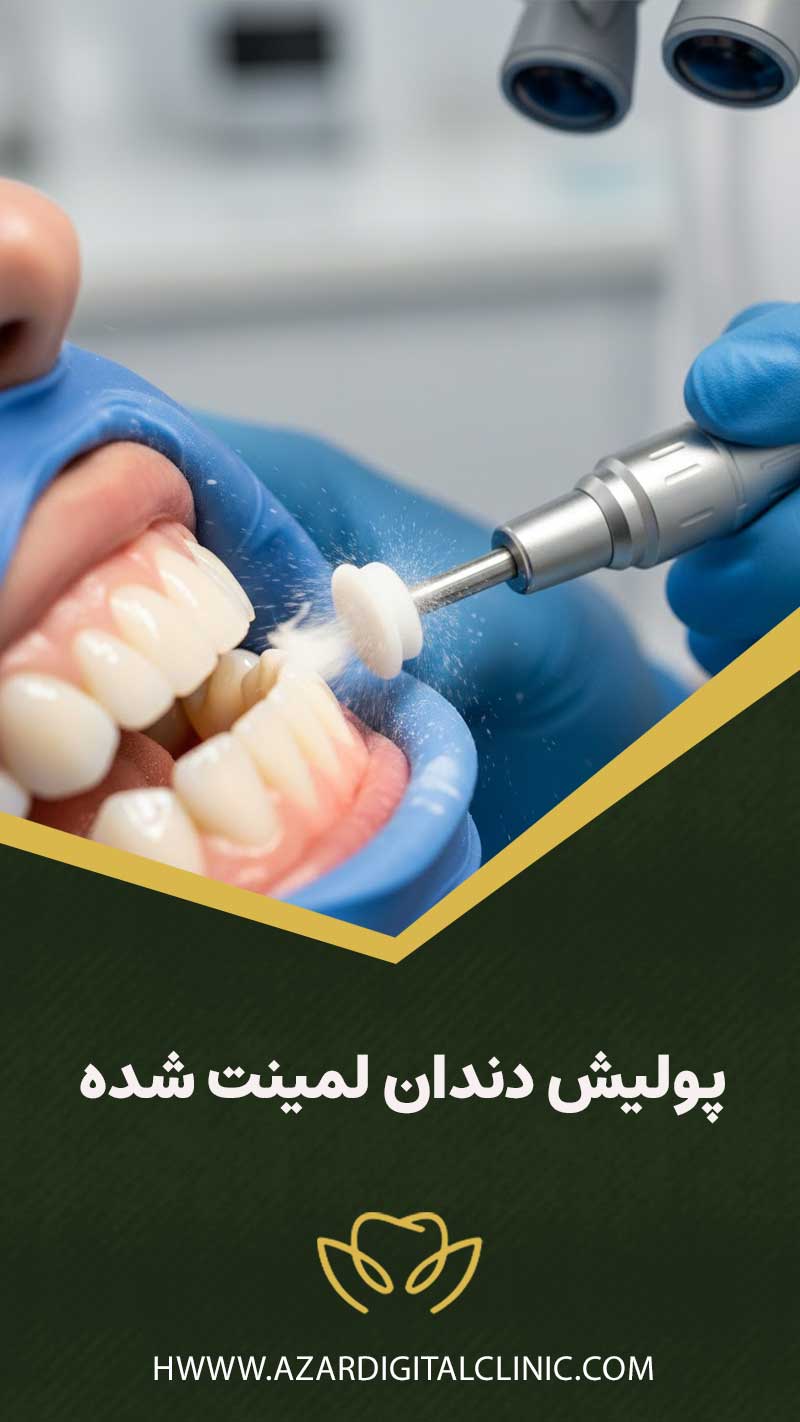 پولیش دندان لمینت شده