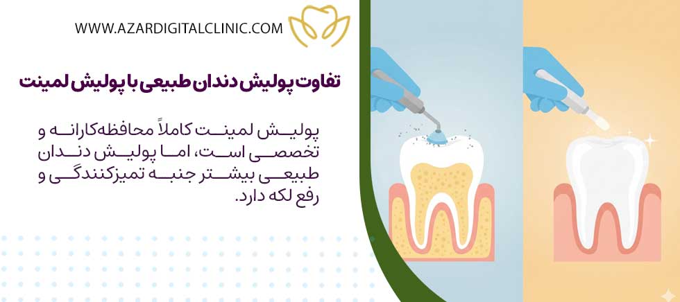 تفاوت حیاتی پولیش دندان طبیعی در مقابل پولیش لمینت دندان