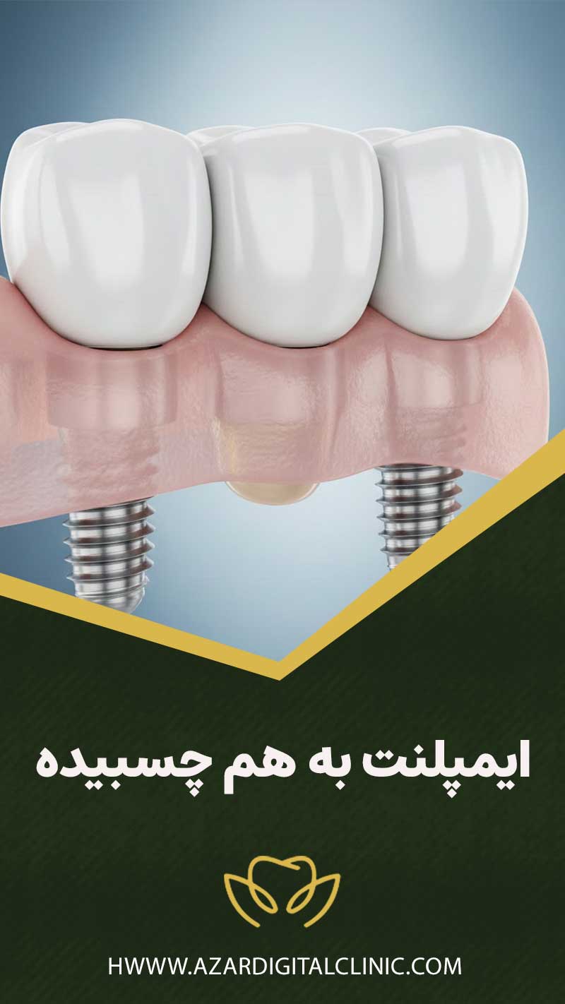 ایمپلنت به هم چسبیده (بریج بر پایه ایمپلنت)