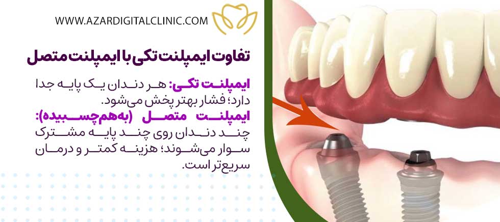 تفاوت ایمپلنت تکی با ایمپلنت متصل