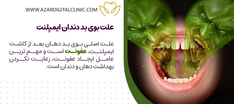 علت بوی بد دندان ایمپلنت چیست؟