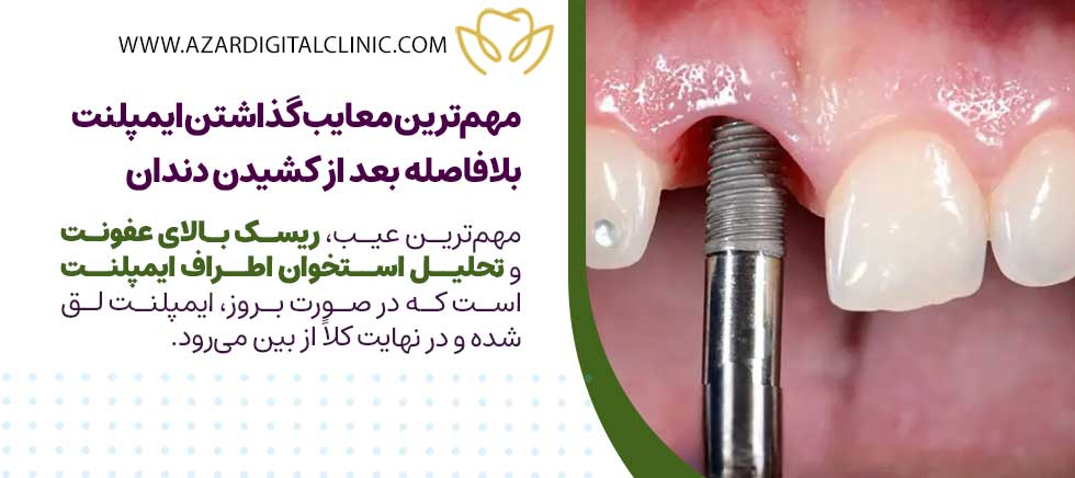 مهم‌ترین معایب گذاشتن ایمپلنت بلافاصله بعد از کشیدن دندان