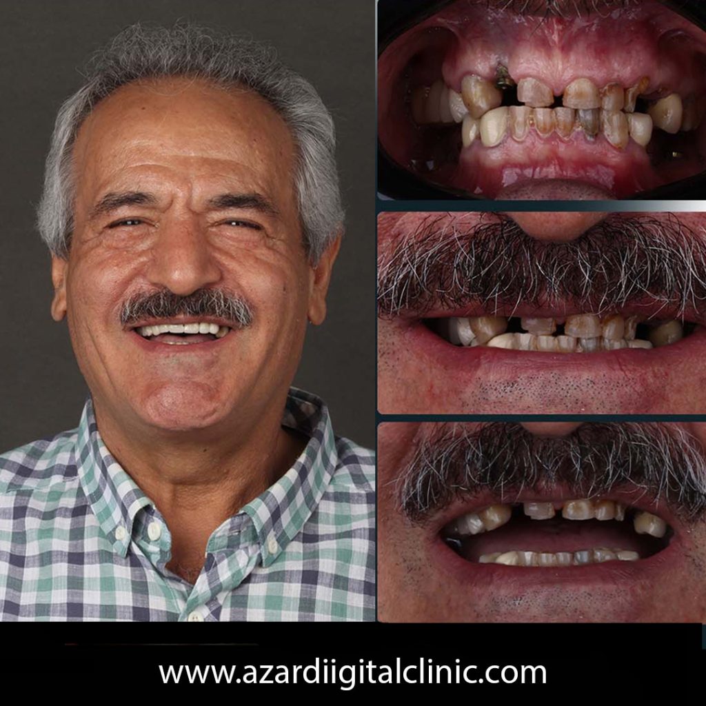 ایمپلنت دیجیتال در اصفهان در کلینیک دندانپزشکی دیجیتال آذر