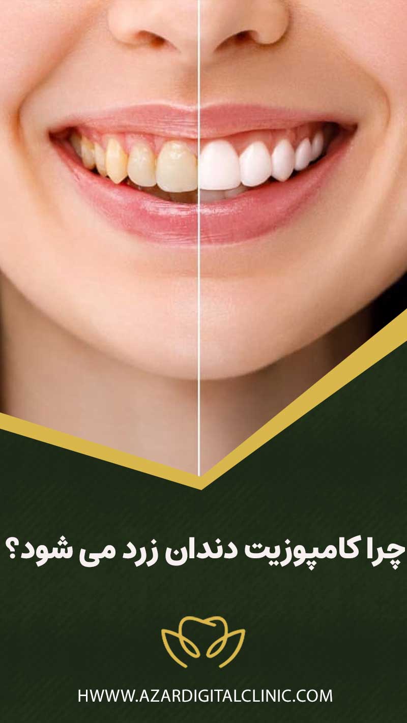 چرا کامپوزیت دندان زرد می‌ شود؟