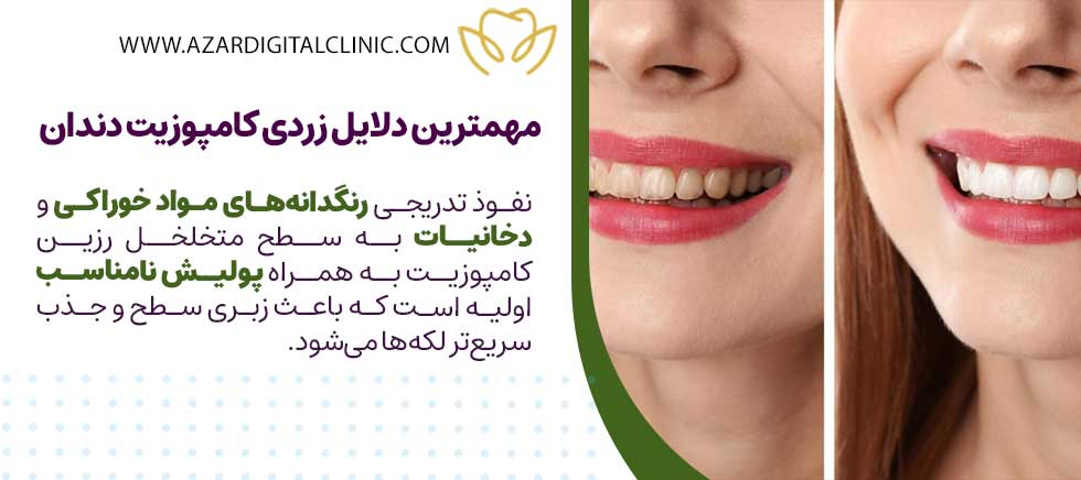 مهمترین دلایل زردی کامپوزیت دندان