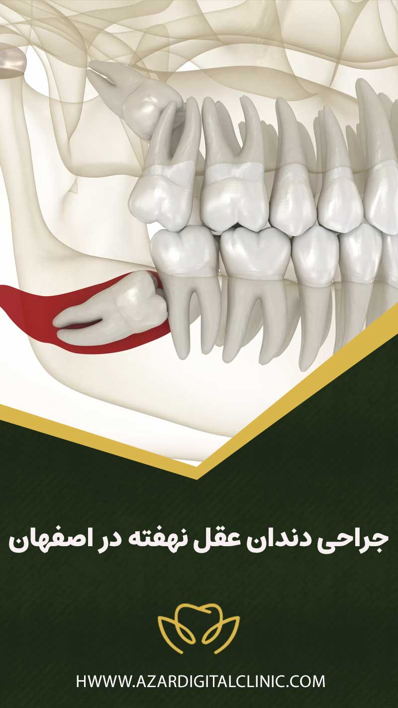 جراح دندان عقل نهفته اصفهان