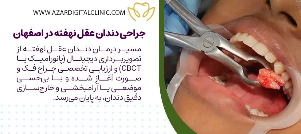 جراحی دندان عقل نهفته در اصفهان