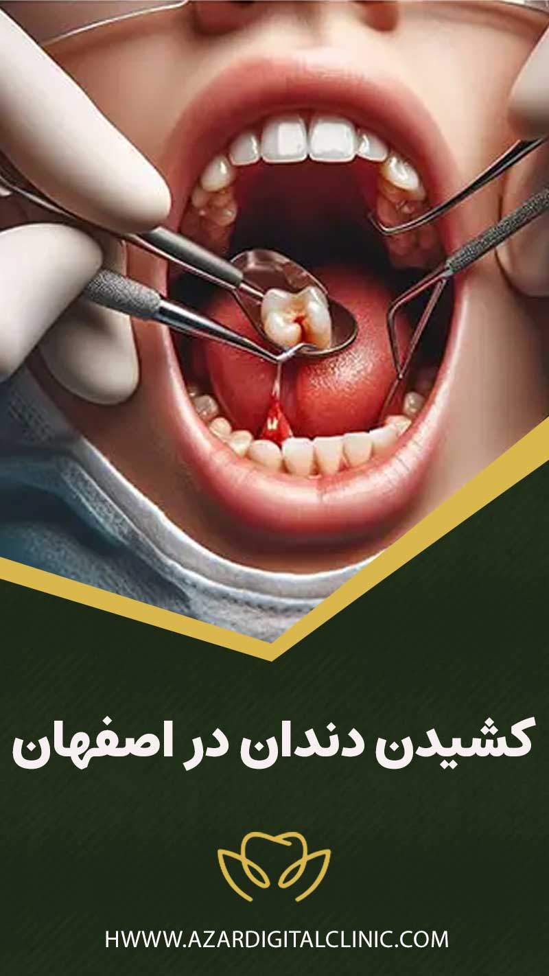 کشیدن دندان در اصفهان