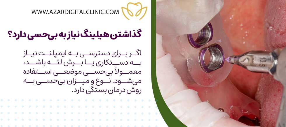 آیا بستن، نصب یا گذاشتن هیلینگ ایمپلنت درد دارد؟
| نحوه بستن هیلینگ ایمپلنت